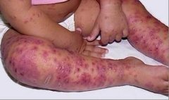 孩子患上湿疹吃什么比较好